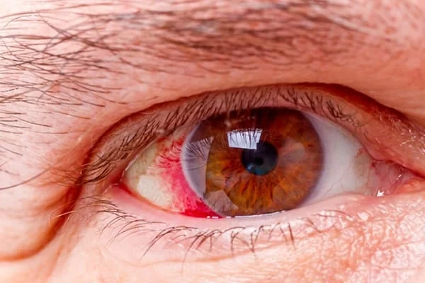 Optic Nerve Damage Warning